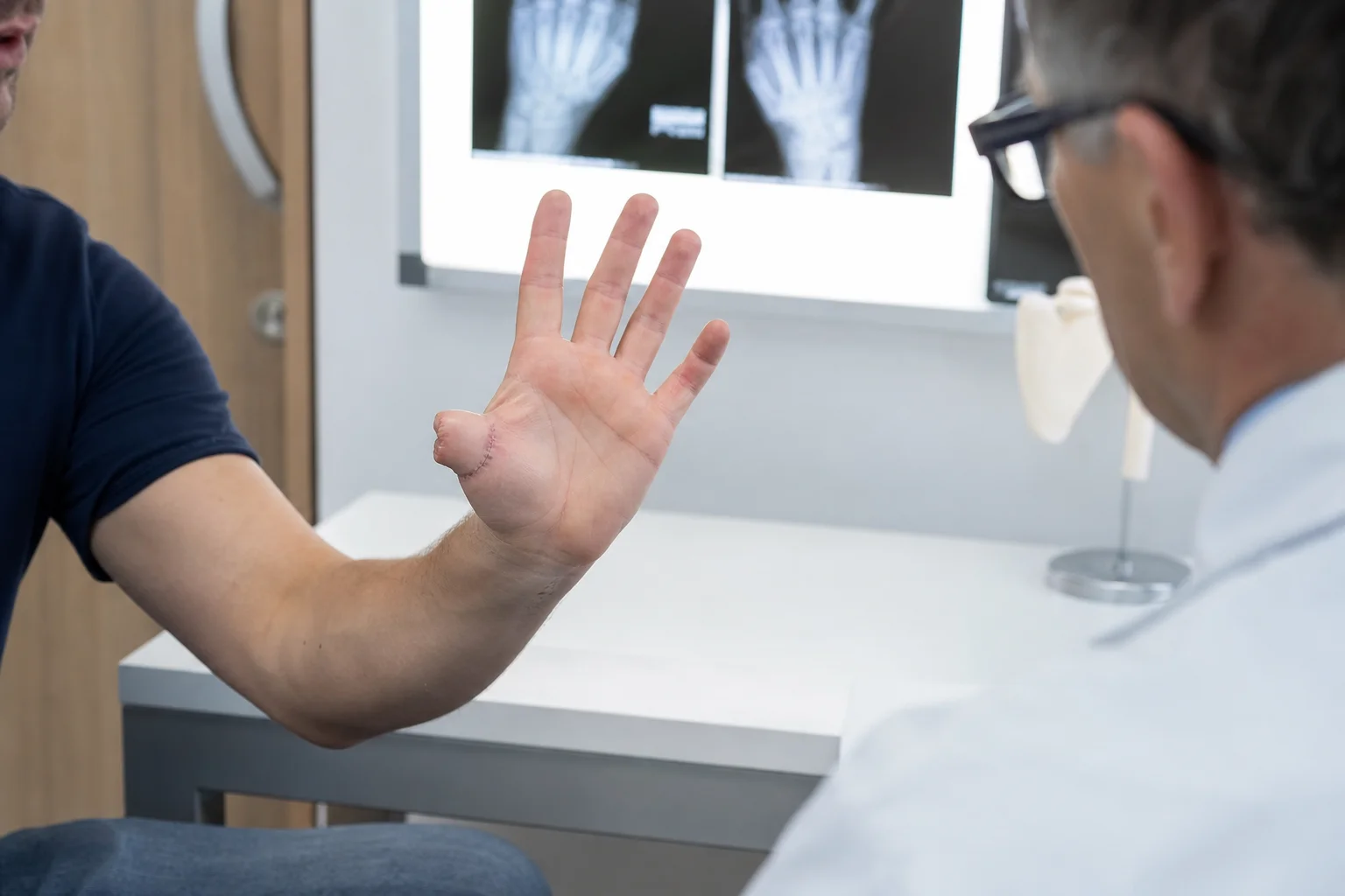 indicatie schadevergoeding verlies vinger indicatie schadevergoeding verlies vinger – smartengeld en letselschade informatie
